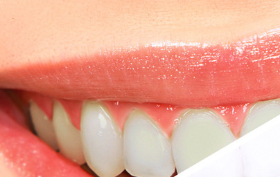 3 naravni načini za beljenje zob