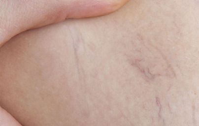 4 vitamini, ki preženejo krčne žile